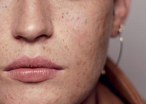 how to treat acne-prone skin